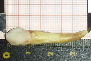 სტომატოლოგმა პაციენტს რეკორდულად დიდი კბილი ამოუღო
