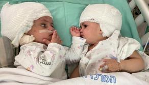 ისრაელში ქირურგებმა სიამის ტყუპები პირველად განაცალკევეს