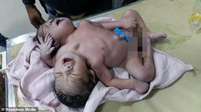 В Индии родился двухголовый и трехрукий ребенок - ФОТО